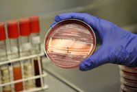Bakterie v Německu mutuje?! 2 mrtvé, 460 nakažených