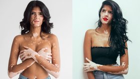 Modelka trpí onemocněním vitiligo