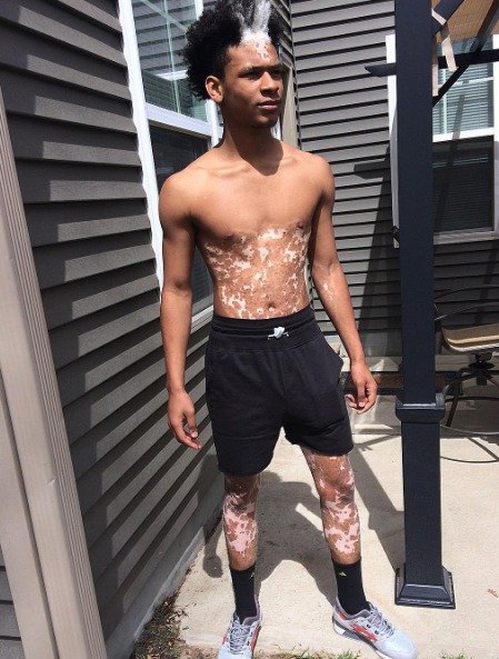 Jak vypadá vitiligo?
