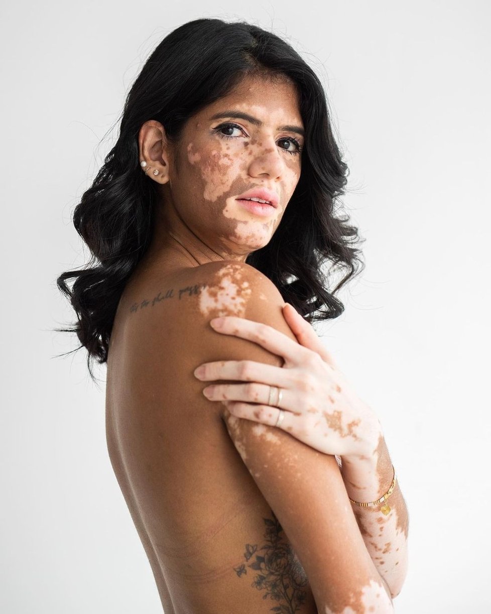 Vitiligo je známé onemocnění