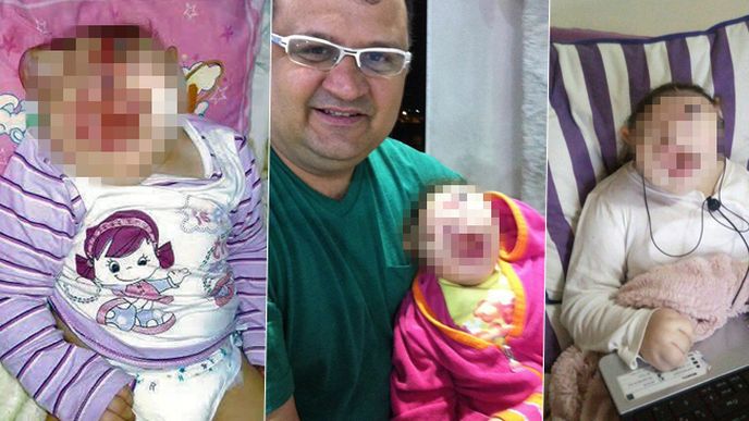 Vitória trpí vzácnou nemocí, kvůli které se jí nevyvinuly kosti v obličeji. Vitória trpí vzácnou nemocí, kvůli které se jí nevyvinuly kosti v obličeji.