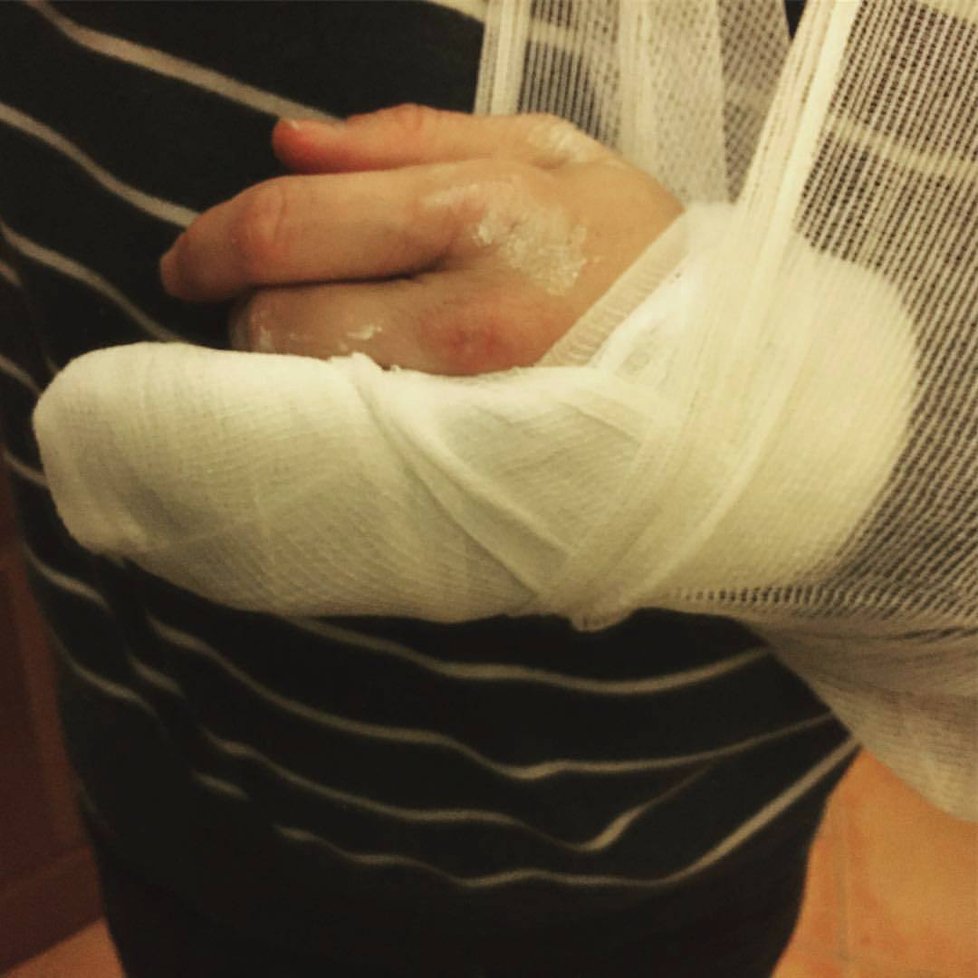 Moderátor Vlasta Korec má zlomenou ruku.