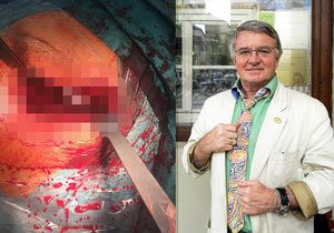 Vlastimil Harapes podstoupil operaci kyčle a pochlubil se fotkou z operačního sálu.