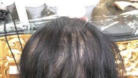 Boj se zrádnou alopecií: fond daruje ženám paruky.