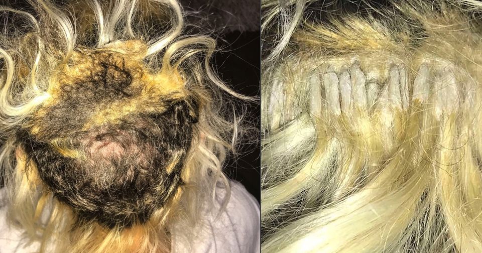 Nejhorší prodloužení vlasů, jaké jste kdy viděli: Kvůli nekvalitnímu lepidlu má teď dívka plešku.