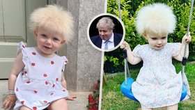 Holčička se narodila se vzácnou genetickou poruchou: Vypadá jako Boris Johnson!