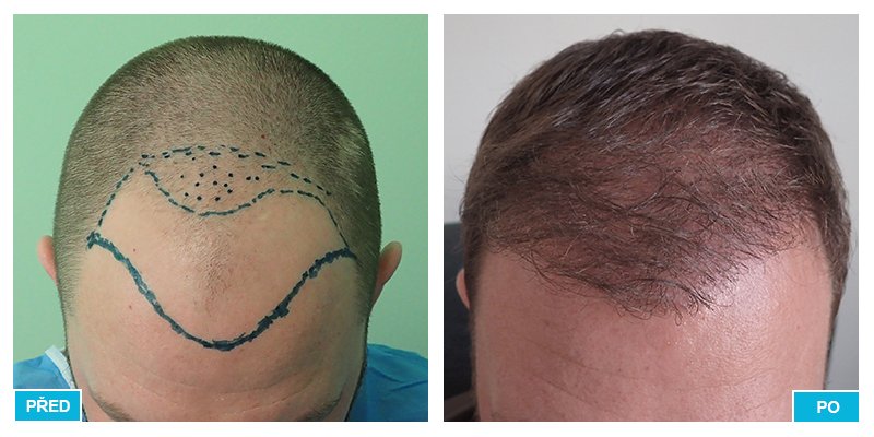 Příklad toho, jak může fungovat transplantace vlasů