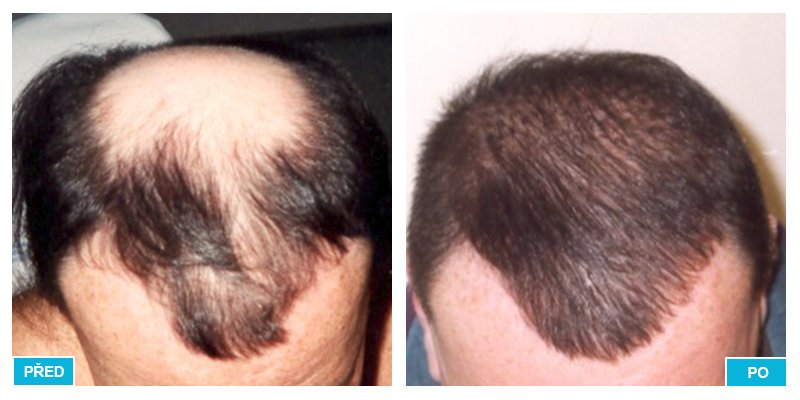 Příklad toho, jak může fungovat transplantace vlasů