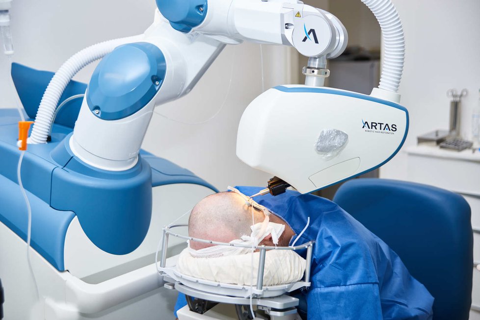 Přístroj Artas, transplantační robot.