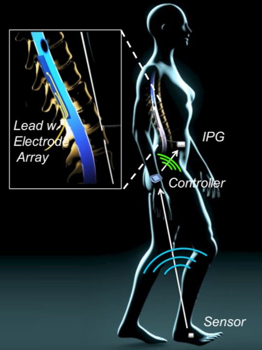 Elektrody v páteři zvedají ochrnuté pacienty zpět na nohy: Vozíčkáři znovu chodí