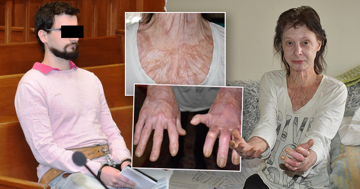 Frýdek-Místek: Una mujer quemada, a quien el Estado no quiere darle una pensión de invalidez, está considerando presentar una demanda