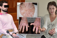 Pyromanem popálená Milada (53) bez invalidního důchodu: Podám žalobu na stát!