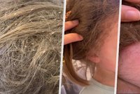 Kadeřnice na TikToku sdílela strašlivé video: Holčičce se ve vlasech hemžily stovky vší!