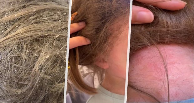 Kadeřnice na TikToku sdílela strašlivé video: Holčičce se ve vlasech hemžily stovky vší!