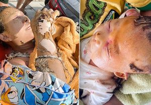 Matka s miminkem utrpěli vážné popáleniny: Po úniku plynu jí vybuchlo kadidlo