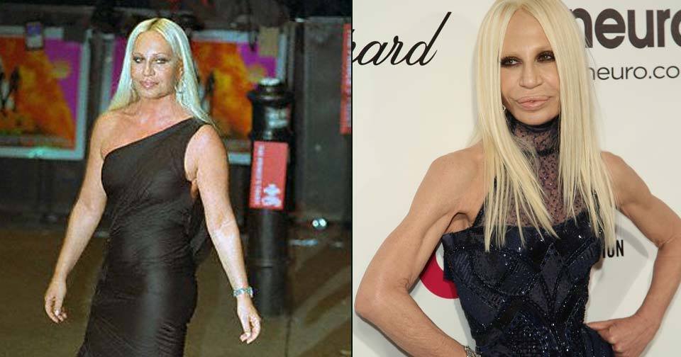 Donatella Versace je chodící kostra. Botox jejímu vzhledu ubližuje ještě více.