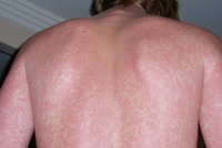 Ketoprofen: Látka z mastí a gelů může reagovat na slunci