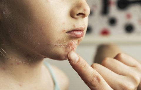 Co je to za pupínky: Velký přehled dětských nemocí s vyrážkou
