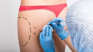 Počet plastických operací skokově roste. Jaké jsou důsledky? Počet plastických operací skokově roste. Jaké jsou důsledky?