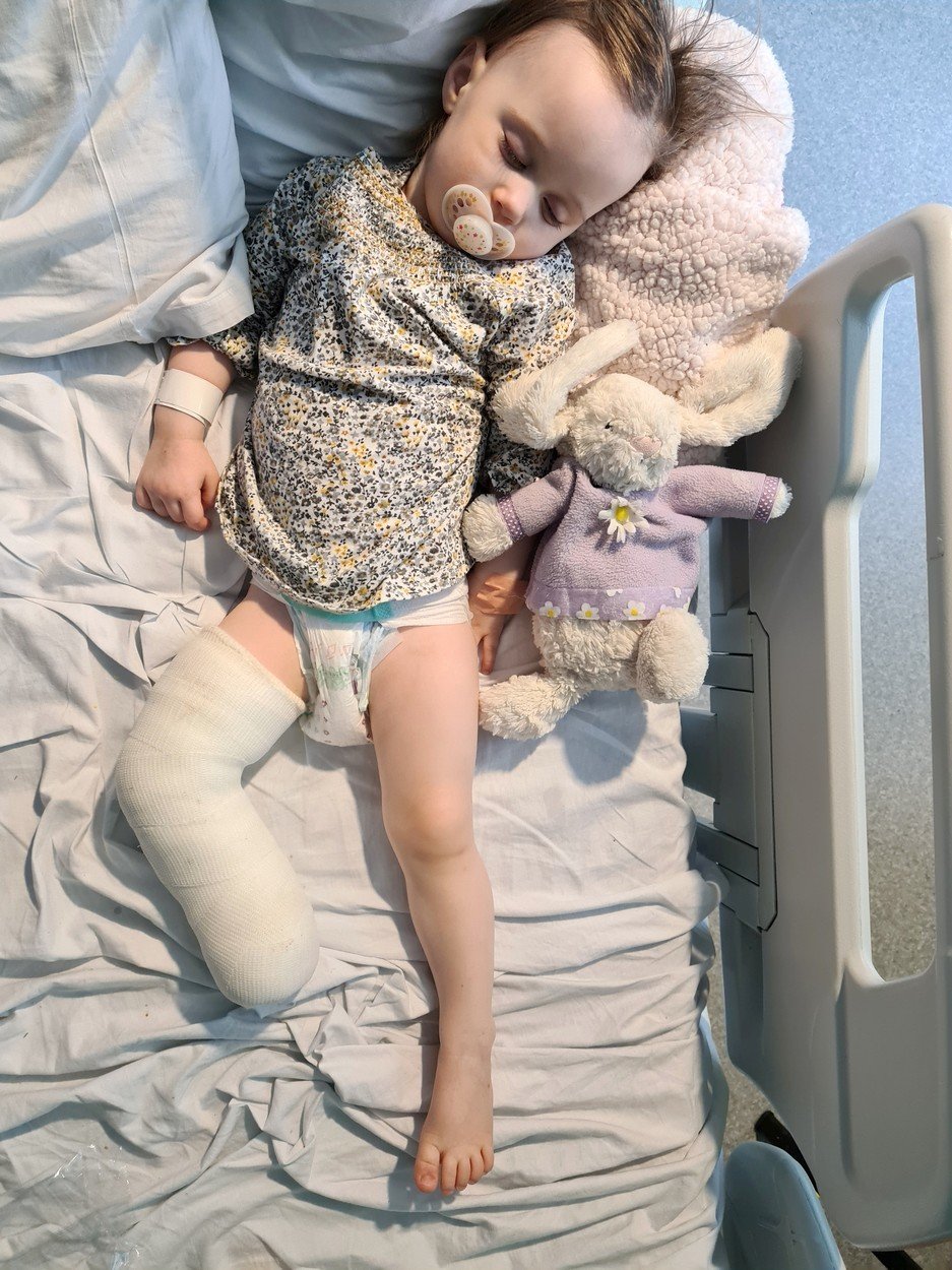 Rodiče Willow kvůli vrozené vadě nechali amputovat nohu.