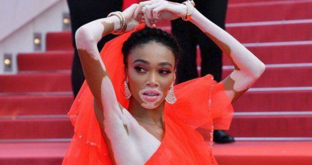 Winnie Harlow