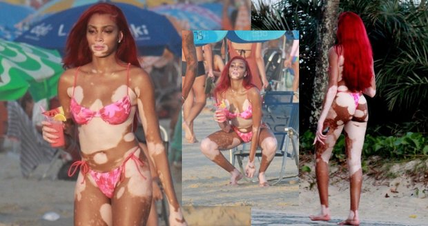 Winnie Harlow už se za své tělo nestydí.