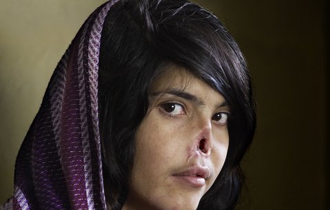 Utrpení zohyzděné dívky vyhrálo World Press Photo