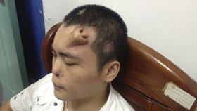 Lékaři vypěstovali Xiaolianovi (22) nový nos na čele pomocí chrupavek z žeber