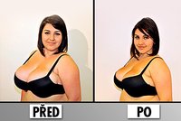Zmenšení prsou bez operace: Vysáli jí 2 litry tuku!