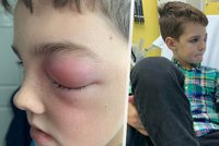 Chlapec (9) s „covidovým okem“ málem přišel o zrak. Vánoce strávil v nemocnici