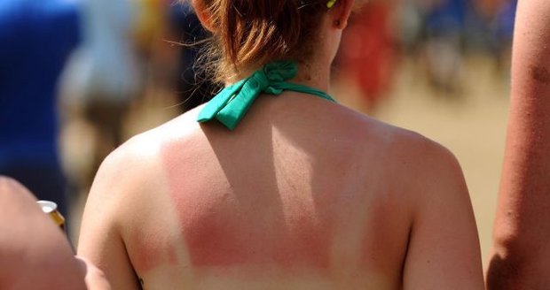 Nebezpečné sluneční paprsky: Kůži můžou sežehnout až na 2. stupeň popálení