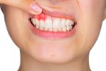 Při parodontóze jsou tkáně postiženy zánětem, který vzniká působením bakterií, tzv. parodontálních patogenů, které uvolňují jedovaté látky.