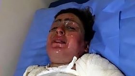 Hrůzné fotky mladé Iráčanky: Manžel ji polil benzinem a zapálil.