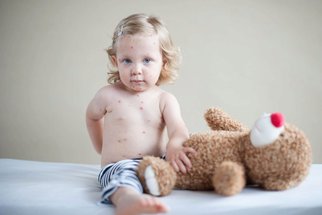 Velký přehled nemocí s vyrážkou u dětí: Jak poznat neštovice, ekzémy i meningitidu Velký přehled nemocí s vyrážkou u dětí: Jak poznat neštovice, ekzémy i meningitidu