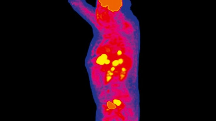Zářící rakovina. Radioaktivní glukózu ve velkém  spotřebovávají nádory. V nich při rozpadu radioaktivního fluoru vzniká záření gama, které zachycují PET kamery. Pacientovi na snímku tak lékaři zjistili nádor konečníku a metastázy v játrech (žluté skvrny).