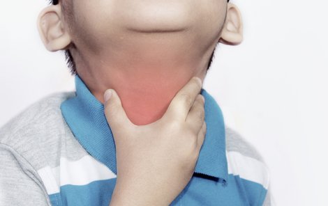 U dětí se  záškrt projevuje bolestí v  krku, otokem  a sípavým kašlem.