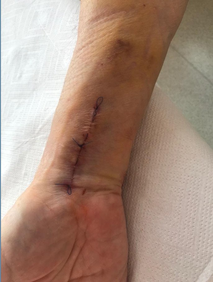 Bartákova ruka po operaci zlomeného zápěstí.