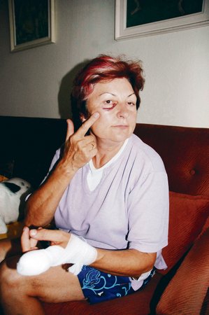 Do smrti budu mít kvůli alkoholikovi znetvořený ukazovák, postěžovala si Zdeňka Uherková (62), která má pod okem monokl