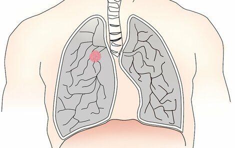 Plíce - rakovina