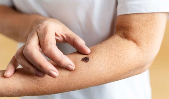 Zkontrolujte si po létě znaménka, čas při zahájení léčby hraje významnou roli Zkontrolujte si po létě znaménka, čas při zahájení léčby hraje významnou roli