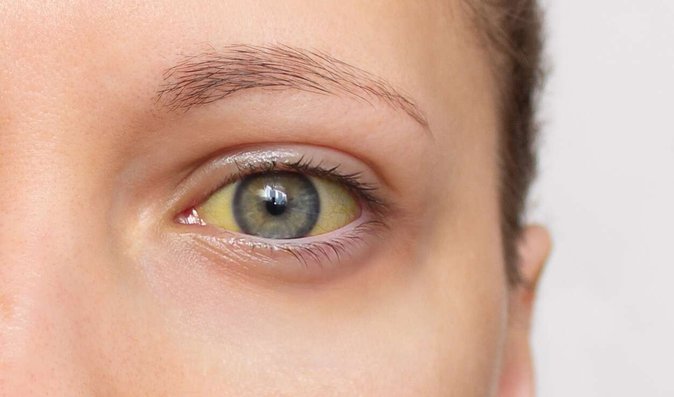 Žloutenka typu A je stále na vzestupu. Jak se chránit, kde a za kolik se nechat očkovat Žloutenka typu A je stále na vzestupu. Jak se chránit, kde a za kolik se nechat očkovat