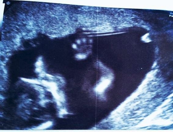 A takhle malá Sára mávala prostřednictvím ultrazvuku