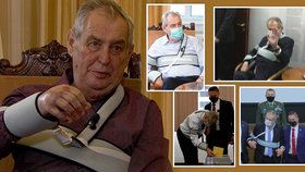 Miloš Zeman má ortézu  na operované ruce místo šesti až osmi týdnů už téměř čtyři měsíce. Podle lékařů ji ale může sundat u doma