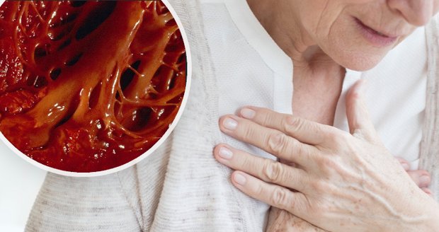 Ženy mohou mít úplně jiné příznaky infarktu než muži