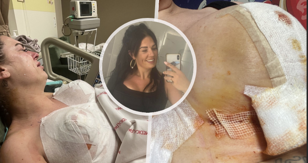 Maminka v Turecku podstoupila operaci prsou: Ze stehů vytékal hnis, žena prožívala nesnesitelná muka!
