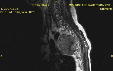 Takhle vypadal nádor na magnetické rezonanci.