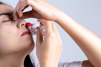 Časté krvácení z nosu: Kdy je to v pořádku a kdy je čas navštívit lékaře?