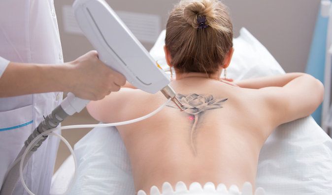 Mýty o odstranění tetování. Jaké máte možnosti? A bolí to?