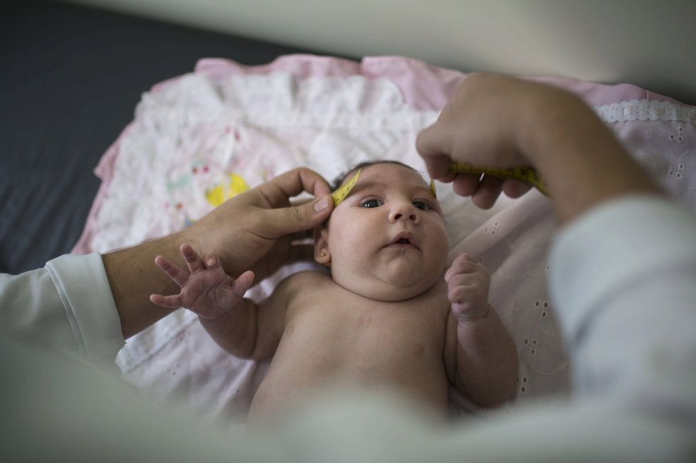 Virus zika způsobuje, že se nakaženým matkám rodí děti s výrazně menší hlavou, což je často zapříčiněno nedostatečně vyvinutým mozkem.