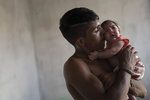 Virus zika způsobuje, že se nakaženým matkám rodí děti s výrazně menší hlavou, což je často zapříčiněno nedostatečně vyvinutým mozkem.